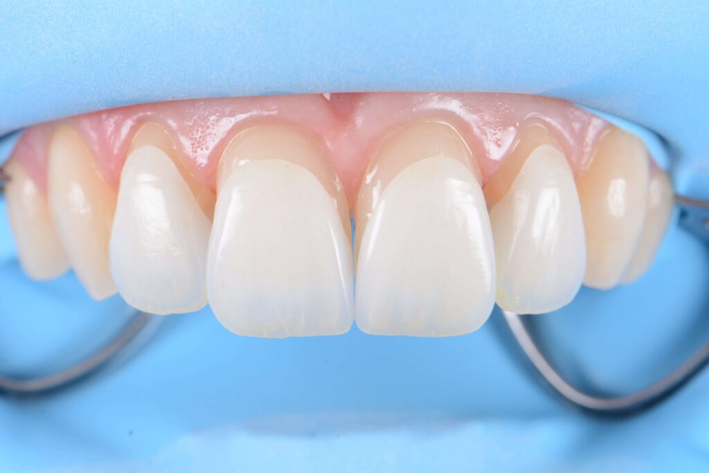 veneers